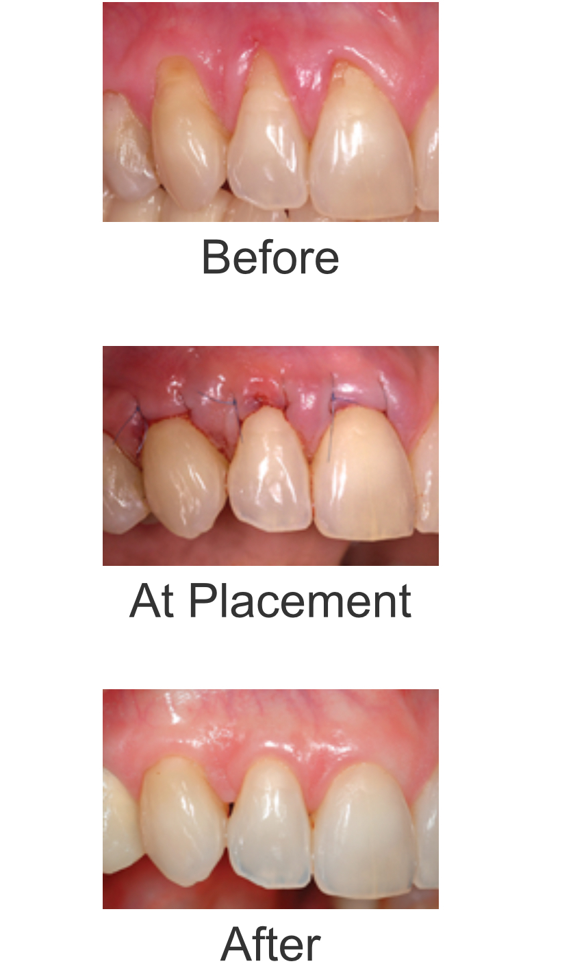 Gum Graft Gum Graft