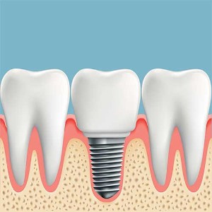 Dental Implant Dental Implant