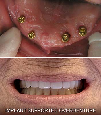 Implant Supported Overdenture Implant Supported Overdenture