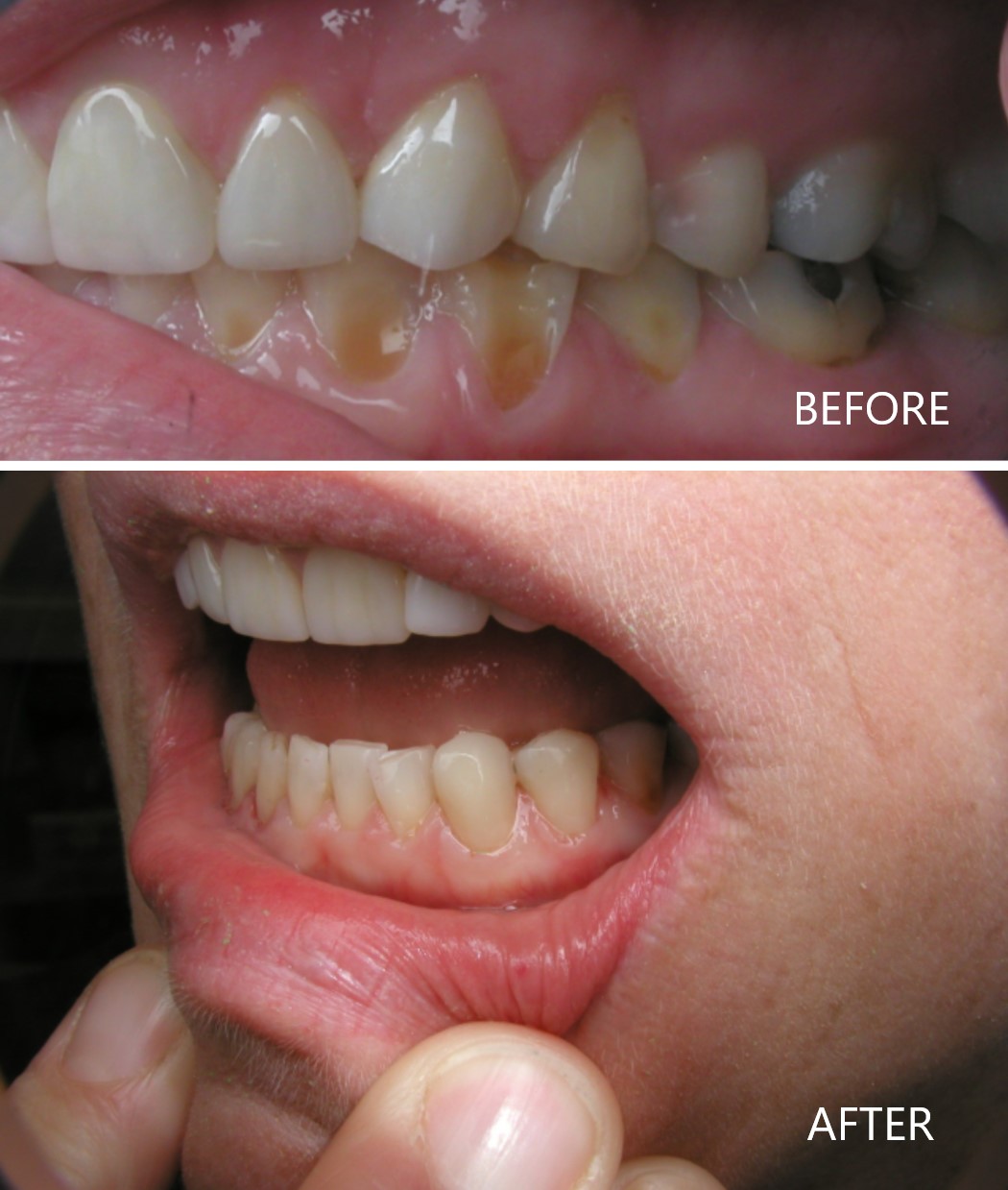 Tooth-Colored Fillings Tooth-Colored Fillings