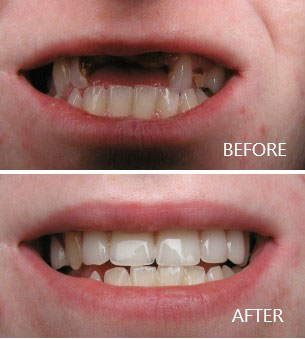 Implant Supported Overdenture Implant Supported Overdenture