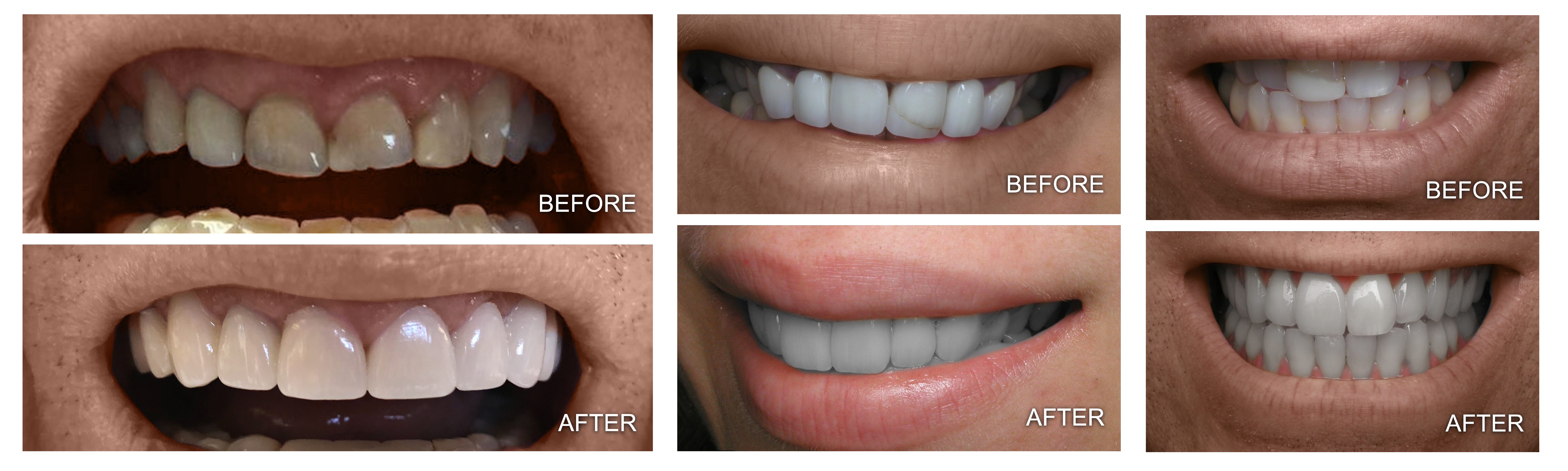 Before and After Our Dental Services in Framingham, MA