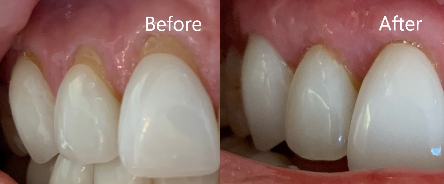 Gum Grafts