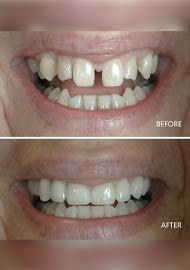 Before and After 1
