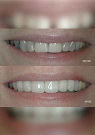 Before and After 2