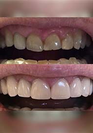 Before and After 3