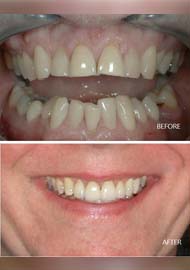 Before and After 4