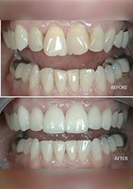 Before and After 6