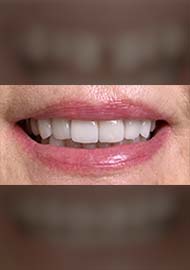 Before and After 15