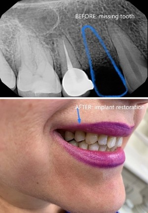 Before and After Implant Restoration Before and After Implant Restoration