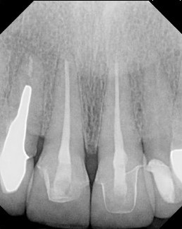 Root Canal Root Canal